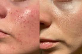 Acne-prone skin close-up on cheek – professional treatment at Bright Luxe Salon &amp; Studio